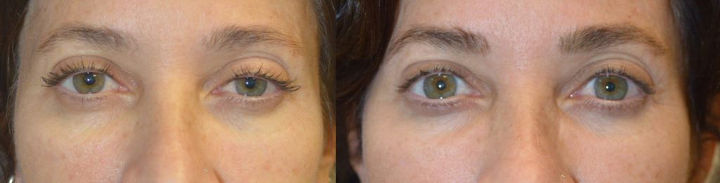 Beverly Hills Eyelid Ptosis Correction