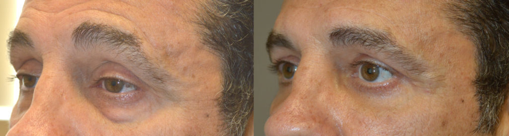 Eyelid Lift Procedure