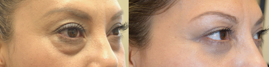 Baggy Under Eyes Surgery Beverly Hills