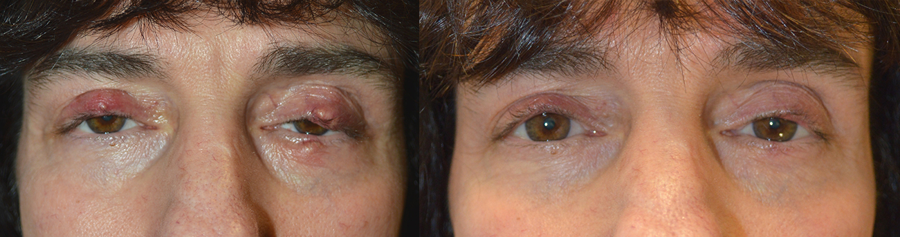 Eyelid Chalazion Oculoplasty Treatment Photos In Los Angeles