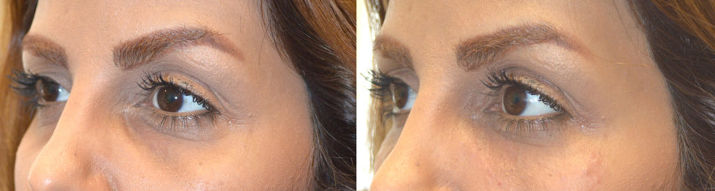 Facial Under Eye Filler Beverly Hills