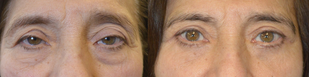 Los Angeles Droopy Eye Surgery