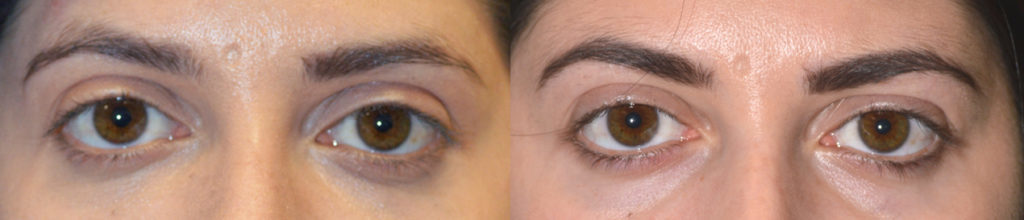 Dermal Filler Eye Rejuvenation