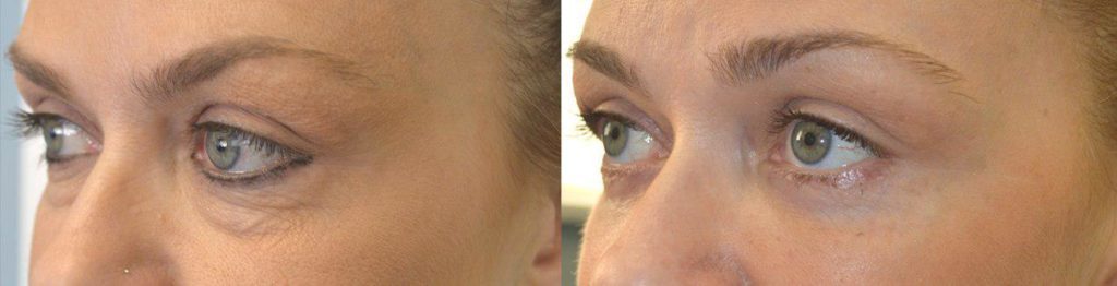 Dark Circles Eye Surgery Los Angeles