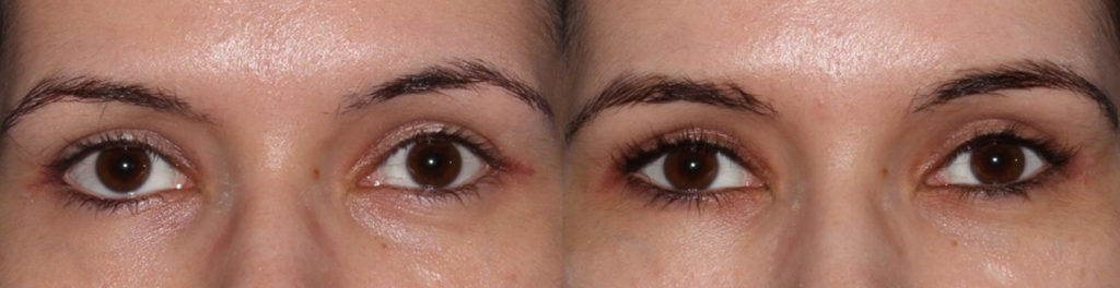 Young female, complained inherited lower eyelid retraction with sclera show and eye asymmetry and rounded eyes. She underwent Almond Eye Surgery including lower eyelid retraction surgery (with soof lift, no spacer graft) and canthoplasty to create more attractive almond shaped eyes. Before and 6 months after cosmetic eyelid surgery photos are shown.