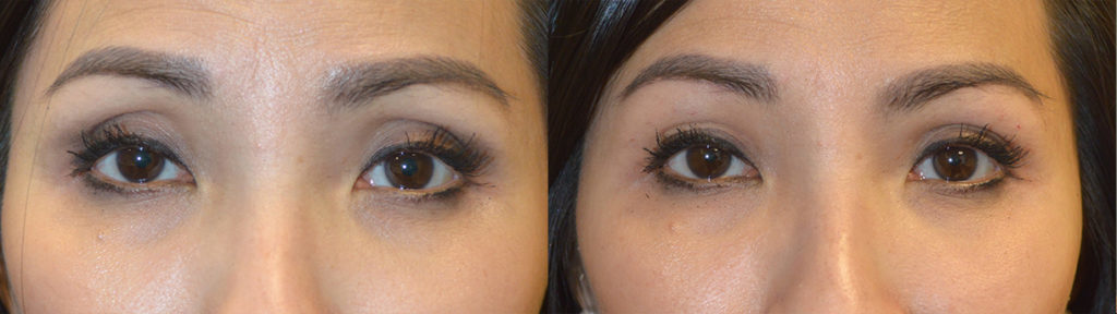 Beverly Hills Dermal Filler Sunken Eyes