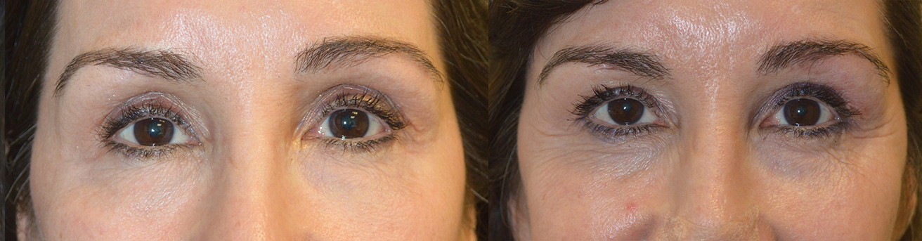 Eye Asymmetry