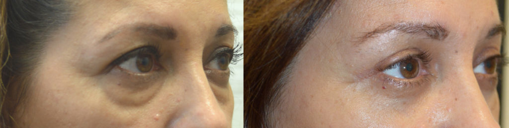 Beverly Hills Lower Blepharoplasty Under Eye Bags