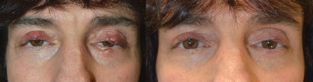 Los Angeles Chalazion Eyelid Procedure