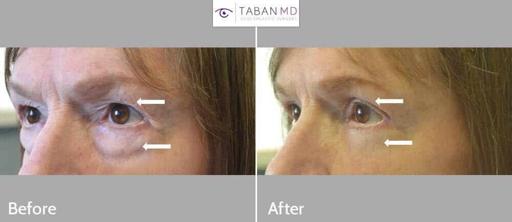 70+ year old female, complained of saggy upper eyelids and under eye bags, looking tired and older, underwent cosmetic male upper blepharoplasty and transconjunctival lower blepharoplasty (transconjunctival technique with eye fat bags repositioning to the tear tough area plus skin pinch), resulting in more rested youthful eye appearance with natural results.