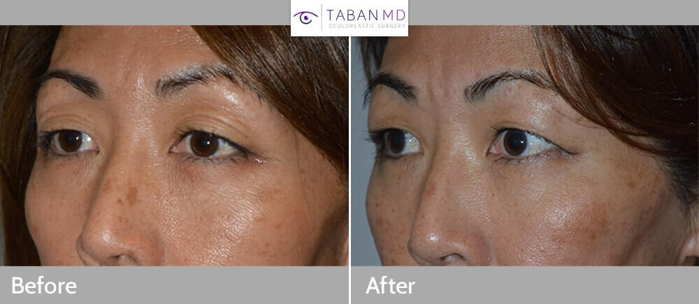 52 Year Old Asian female with fat injection/transfer in upper eyelids and brows, to help stretch the loose saggy skin. Before (left), After (right).