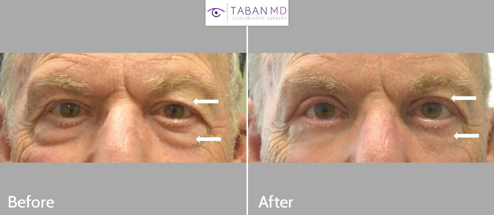70+ year old male, complained of saggy upper eyelids and under eye bags, looking tired and older, underwent cosmetic male upper blepharoplasty and transconjunctival lower blepharoplasty (transconjunctival technique with eye fat bags repositioning to the tear tough area plus skin pinch), resulting in more rested youthful eye appearance with natural results.