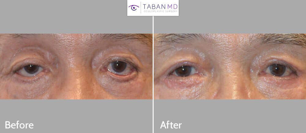 73 year old Asian male, with significant lower eyelid cicactricial ectropion and eyelid scarring after previous blepharoplasty (done by another surgeon), underwent revision eyelid surgery including lower eyelid ectropion surgery with skin graft, revision canthoplasty, revision eyelid ptosis (droopy eyelid) surgery, and revision blepharoplasty. Before and 3 months after reconstructive and cosmetic eyelid surgery photos are shown. Post-blepharoplasty lower eyelid ectropion can occur with transcutaneous lower blepharoplasty and it is prevented by transconjunctival lower blepharoplasty.