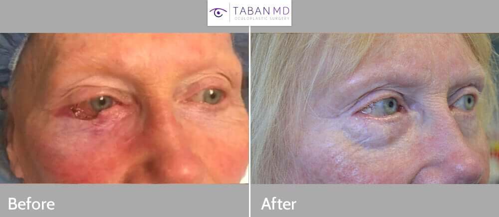 76 year old female, underwent right lower eyelid skin cancer (basal cell carcinoma) Mohs resection and reconstruction of the eyelid. Before and after eyelid surgery photos are shown.