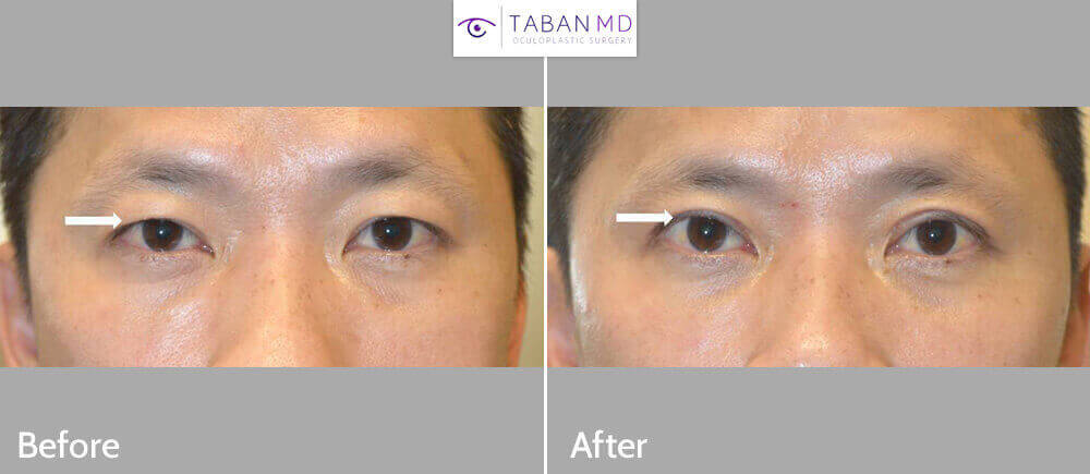 Asian man underwent cosmetic Asian upper blepharoplasty with crease formation. Asian blepharoplasty needs to consider the natural Asian eye shape and eyelid structures to provide natural results. Before and 3 months after cosmetic eyelid surgery photos are shown.