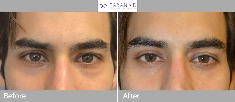 27 year old male actor, complained of looking tired on camera due to under eye bags and dark circles (hollowness). He underwent cosmetic lower blepharoplasty (transconjunctival with fat bags repositioning). Before and 2 months after cosmetic eyelid surgery photos are shown.