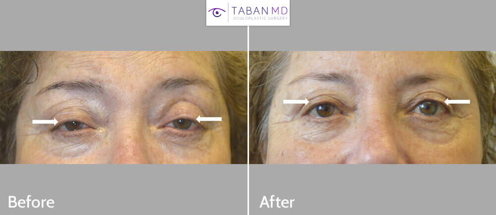 65+ year old female, with history of prior upper blepharoplasty (by another surgeon), complained droopy upper eyelids with trouble keeping eyes open. She underwent scarless internal droopy upper eyelid ptosis surgery, resulting in more natural rested eye appearance. Before and 2 months after eyelid plastic surgery photos are shown.