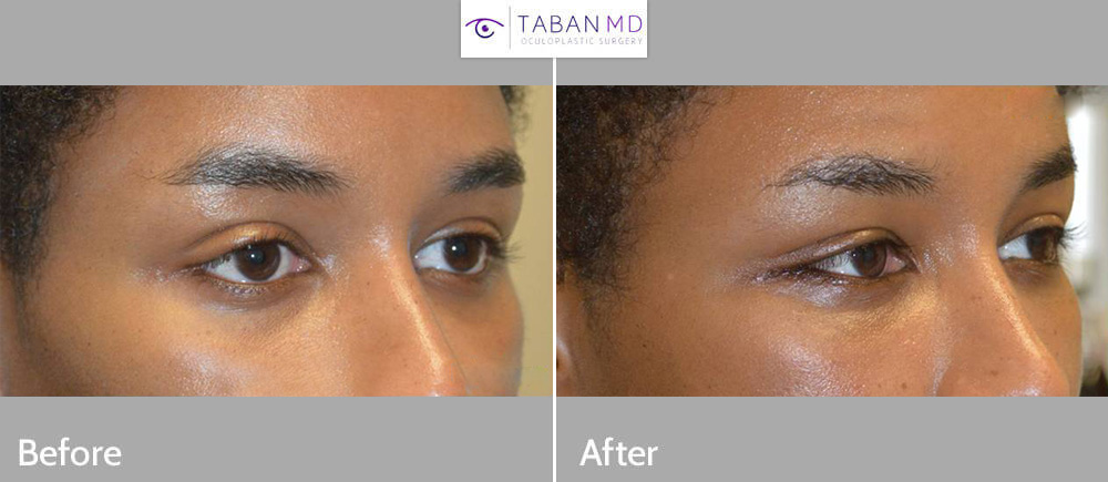Young person, underwent combined almond eye surgery and infraorbital rim implant and scarless internal upper eyelid ptosis surgery. Note more almond shaped eyes.