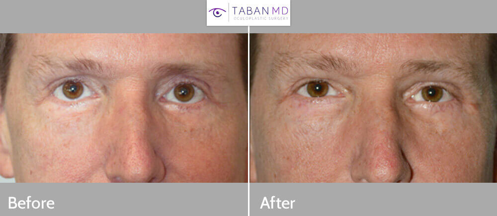 Middle age man, with lower eyelid retraction after previous aggressive lower blepharoplasty, with rounded eyes and sclera show, underwent reconstructive revision eyelid plastic surgery: lower eyelid retraction surgery (with internal graft and midface lift) and canthoplasty, to create more natural almond eye shape. Preop and 4 months postoperative photos are shown.