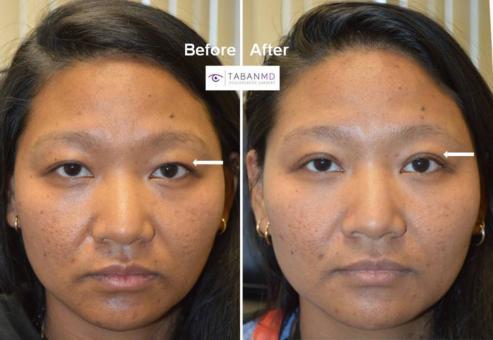 Young Asian woman, with asymmetric upper eyelid crease, underwent customized Asian upper blepharoplasty (double eyelid surgery). Her sister also underwent similar procedure with me.