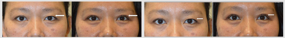 Young Asian woman, with asymmetric upper eyelid crease, underwent customized Asian upper blepharoplasty (double eyelid surgery). Her sister also underwent similar procedure with me.