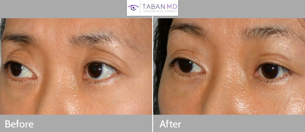 Young Asian female, with prior aggressive upper blepharoplasty, where too much fat was removed, resulting in hollow sunken upper eyelids, with excess folds. She received upper eyelid filler injection to give more natural Asian eyelids and shape. Before and 1 month after eyelid filler treatment photos are shown.