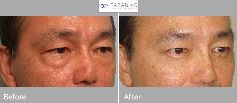 Middle age Asian male, with under eye bags, appearing tired and older, underwent cosmetic lower blepharoplasty (transconjunctival approach) to remove excess eye fat, under local anesthesia in the office. Note natural, rested eye appearance after surgery. Before and 3 months after eyelid plastic surgery photos are shown.