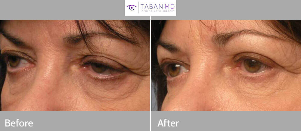 Middle age woman, with eyelid aging, droopy upper eyelids (ptosis), under eye bags/wrinkles, and droopy lower eyelids, underwent cosmetic lateral canthoplasty (plastic surgery on outer corner of the eye), upper and lower blepharoplasty (to remove excess skin and fat) and eyelid ptosis repair (to lift upper eyelids), resulting in more youthful, natural almond shape eyes. Preop and 3 months postoperative photos after cosmetic eyelid surgery are shown.