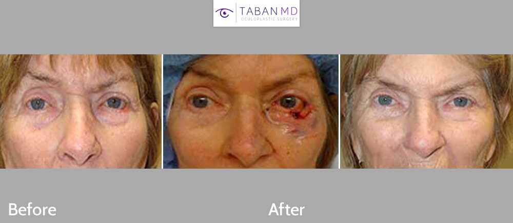 Before (left), intraop (middle) and 3-months after (far right) photos of a patient with large left lower eyelid skin cancer Mohs resection and reconstruction.