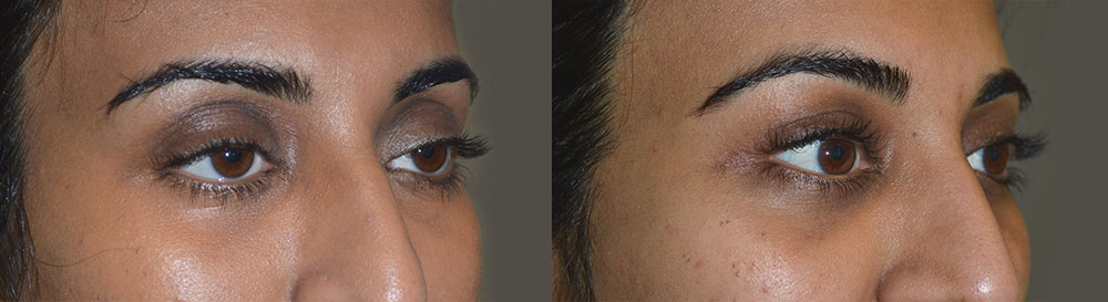 Before (left) 32 year old female, with droopy upper eyelids (ptosis). After (right) 3 months after cosmetic droopy upper eyelid (ptosis) surgery and fat injection.