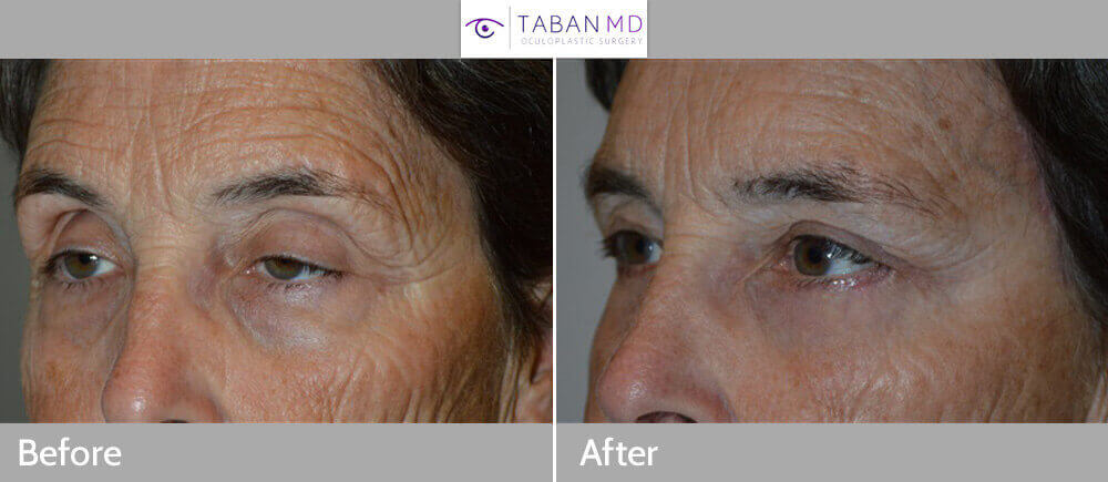 60+ year old female, complained of droopy upper eyelids, saggy eyebrows, bags under eyes, and wrinkles around eyes. She wanted eyelid lift and others procedures to make her eyes look better. We note she upper eyelid ptosis (droopy upper eyelids), excess skin in upper eyelids, droopy outer eyebrows, and under eye fat prolapse. She underwent cosmetic eyelid plastic surgery to include upper eyelid ptosis surgery (to raise upper eyelids and open eyes), upper eyelid blepharoplasty (to removed excess upper eyelid skin), lateral brow lift (using hidden temple pretrichial incision along the hairline), and lower transconjunctival blepharoplasty (with fat repositioning where the fat bags were distributed to fill in hollow under eye area). All the eyelid procedures were done in one setting, under local/sedation anesthesia, with practically painless recovery. Preop and 3 months postoperative photos are shown. Note more youthful eye appearance with natural results, with better eye opening, better brow contour, and less wrinkles and bags around eyes.