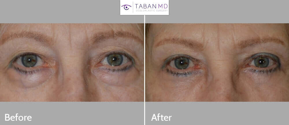 68 year old female, wanted eye rejuvenation to less tired and old. She has extra upper eyelid skin, resting on her lashes, which prevent proper application of makeup. She also has under eye bag (fat prolapse). She underwent cosmetic quad-blepharoplasty, meaning bilateral upper blepharoplasty (with skin removed from upper eyelids) and bilateral lower blepharoplasty (transconjunctival incision with fat redraping), under local anesthesia in the office. Note improved, natural eye appearance with patient looking more rested and youthful. Preop and 3 months postoperative photos are shown.