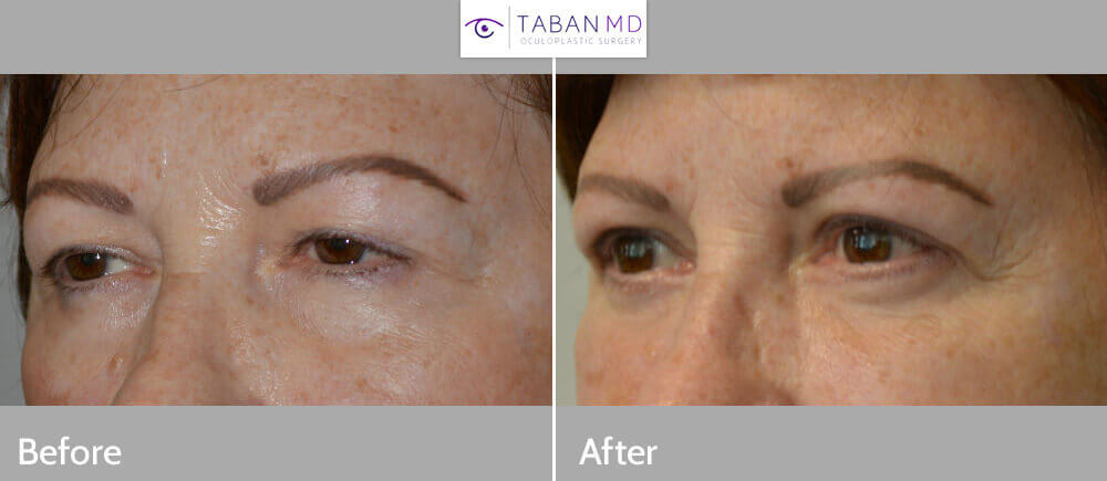 Middle age woman, with heavy droopy upper eyelids (ptosis) and excess upper eyelid skin and under eye bags, wanted eye rejuvenation. She underwent cosmetic eyelid surgery including upper eyelid ptosis repair (to lift the droopy upper eyelids), upper blepharoplasty (to remove excess upper eyelid skin), and lower blepharoplasty (transconjunctival with fat repositioning). 3 months postoperative photos show improvement in eye appearance, with more youthful natural look.