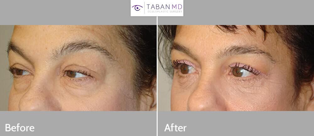 Before (left) and 3 months after (right) quad-blepharoplasty and blepharoptosis surgery.