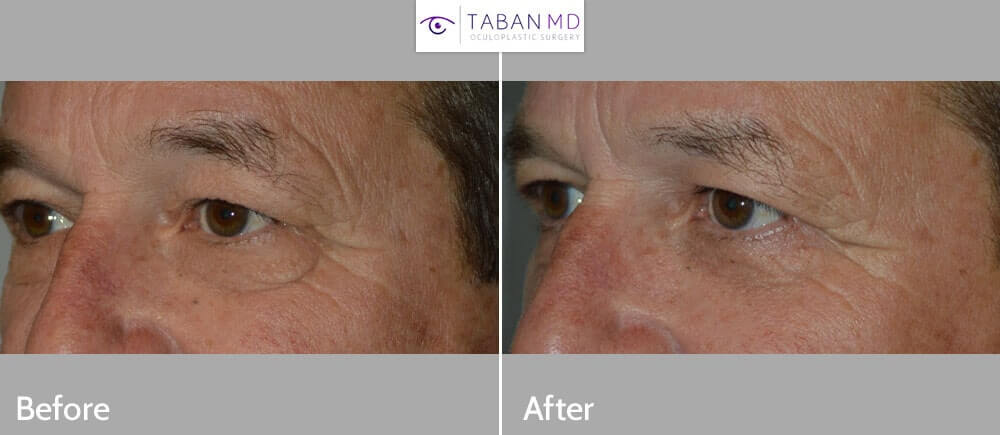 Middle age man, complained of lower eyelid wrinkles and loose skin and bags. He wanted conservative surgery to look younger and better. He underwent male lower blepharoplasty using transconjunctival approach to address under eye bags plus outside skin pinch method to remove excess skin. This aesthetic eyelid procedure was done under local anesthesia in the office, with quick recovery. Preop and 2 months postoperative photos are shown.