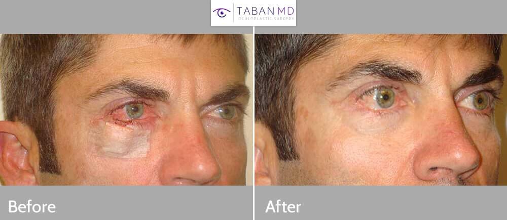 40 year old male, with right lower eyelid defect after Mohs procedure to remove right lower eyelid basal cell carcinoma, resulting from sun damage in light skin individual (right photo). Note nearly half of the lower eyelid is missing. He then underwent right lower eyelid skin cancer reconstruction under local anesthesia. Before and 3 months postoperative photos are shown.