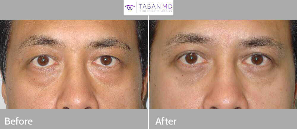 40 year old Asian male, complained of under eye bags (with dark circles) and excess upper eyelid skin. He underwent cosmetic Asian blepharoplasty including Asian upper blepharoplasty with crease formation (incision method) and lower blepharoplasty (transconjunctival with fat repositioning), under local anesthesia in the office. Note natural appearing results for male Asian blepharoplasty. Preop and 3 months postoperative photos are shown.