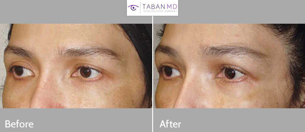 Young female, with mild to moderate upper eyelid hollowness, desired more fullness. She chose to have fat injection (instead of filler injection) in the upper eyelids and sub-brow area. Before and 3 months after eyelid fat transfer photos are shown. Note more youthFUL upper eyelid results.
