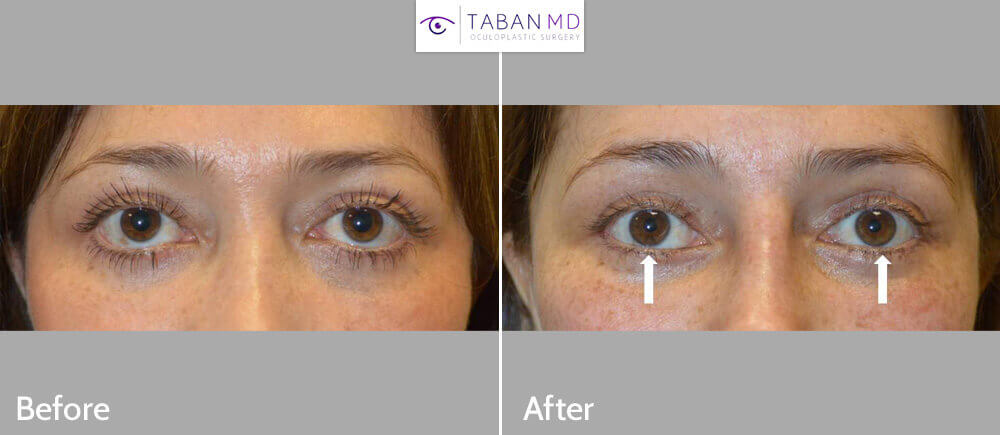 49 year old female, from Mexico City, underwent corrective lower eyelid retraction surgery after previous transcutaneous lower blepharoplasty. Before and 2 months after revision eyelid surgery photos are shown.