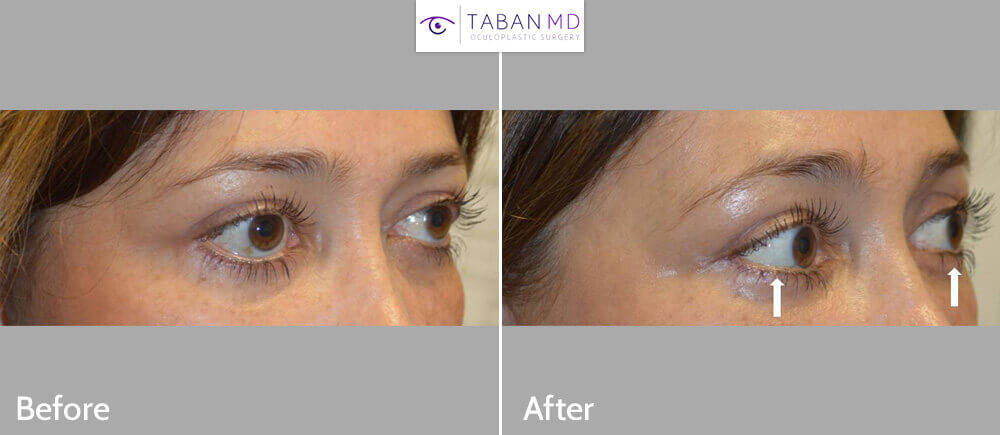 49 year old female, from Mexico City, underwent corrective lower eyelid retraction surgery after previous transcutaneous lower blepharoplasty. Before and 2 months after revision eyelid surgery photos are shown.