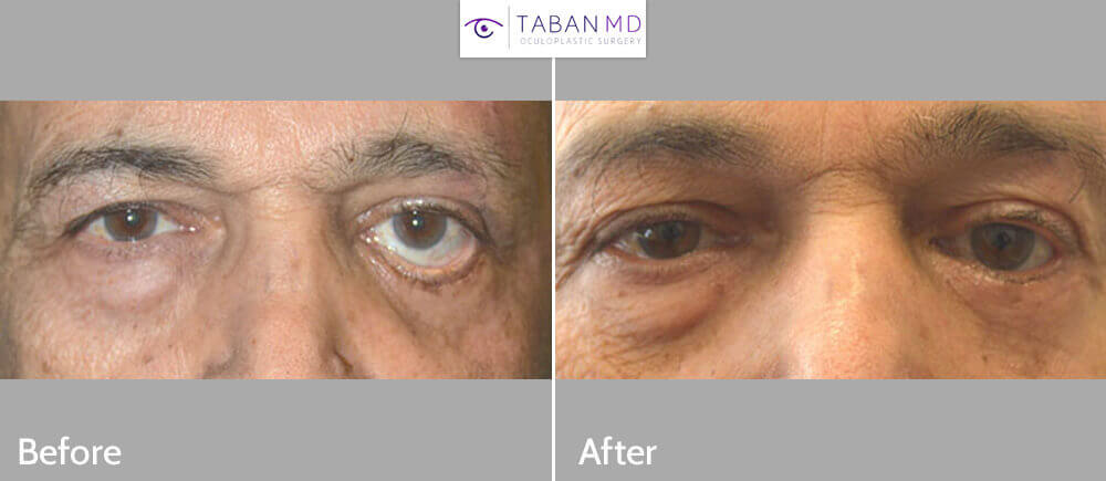Middle age man with severe left lower eyelid retraction after previous lower eyelid surgery with inability to close the left eye, underwent revision left lower eyelid surgery (lower eyelid retraction surgery with internal alloderm spacer graft and external skin graft). Before and 3 months postoperative photos are shown.