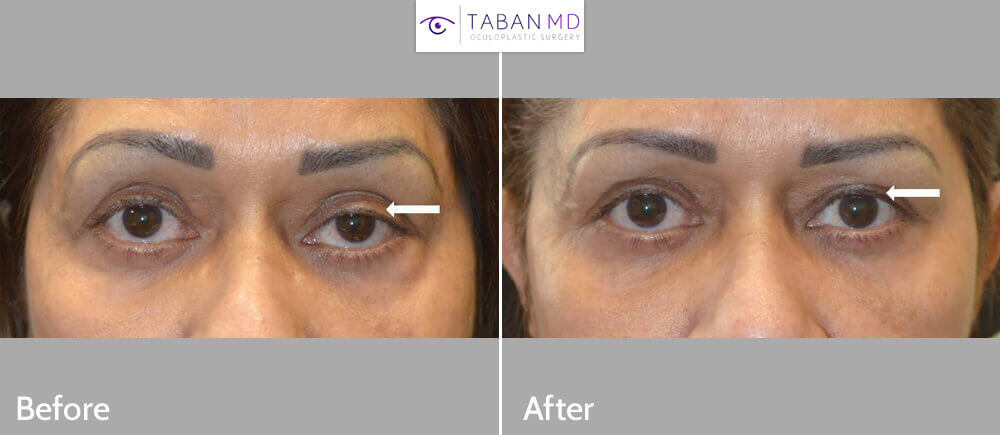 65 year old female, with history of previous failed surgery, underwent revision left upper eyelid ptosis surgery to correct asymmetric droopy upper eyelids. Before and 3 months after photos eyelid surgery photos are shown.