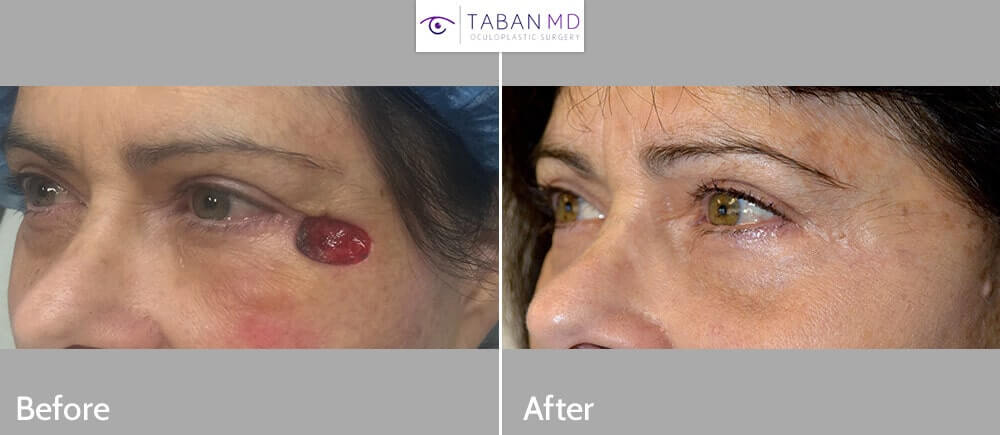 57 year old female, with right eyelid/temple skin cancer (basal cell carcinoma) Mohs defect underwent reconstructive eyelid surgery. Before and 3 months postoperative photos are shown.
