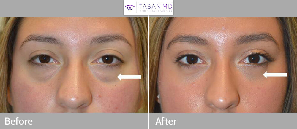 19 year old young woman, with genetic under eye fat bags with dark circles, underwent cosmetic scarless transconjunctival lower blepharoplasty with fat repositioning. Before and 1 month after cosmetic eyelid surgery photos are shown. You can see her full story video of her (before surgery, surgery, postop visits, and full recovery) on our website.