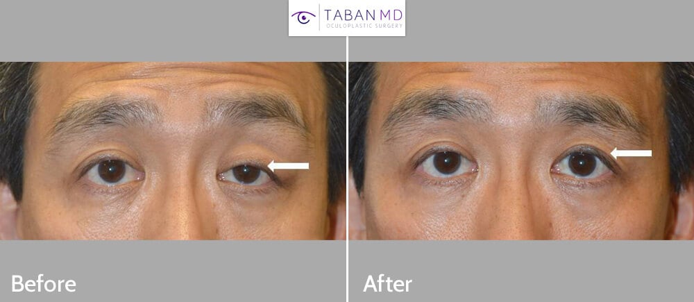 Middle age Asian male, complained uneven eyes with droopy left upper eyelid (ptosis). He underwent scarless left upper eyelid ptosis surgery. Before and 2 months after eyelid procedure photos are shown. Note improved eye symmetry.