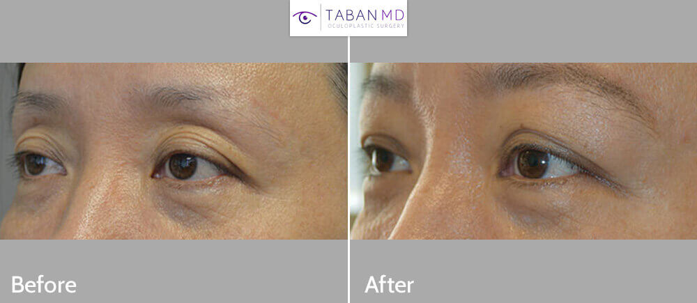 Middle age Asian female, with deflated saggy upper eyelids with excess wrinkles and upper eyelid skin folds, underwent nonsurgical upper eyelid lift using Belotero Filler injection in upper eyelids and under eyebrows. Before and 1 month post-eyelid filler injection photos are shown.
