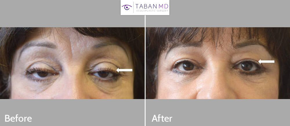66 year old female with significant age-related droopy upper eyelids (ptosis) underwent droopy upper eyelid ptosis repair and blepharoplasty. Before and 3 months after eyelid surgery photos are shown.