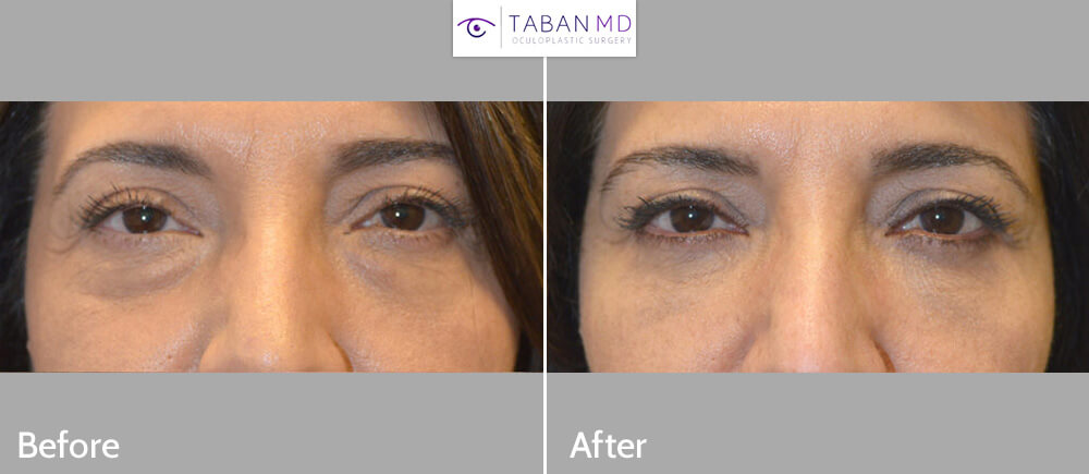 55 year old female, complained of under eye bags and dark circles. She underwent transconjunctival lower blepharoplasty with fat repositioning and skin pinch. Before and 2 months after cosmetic eyelid plastic surgery photos are shown.