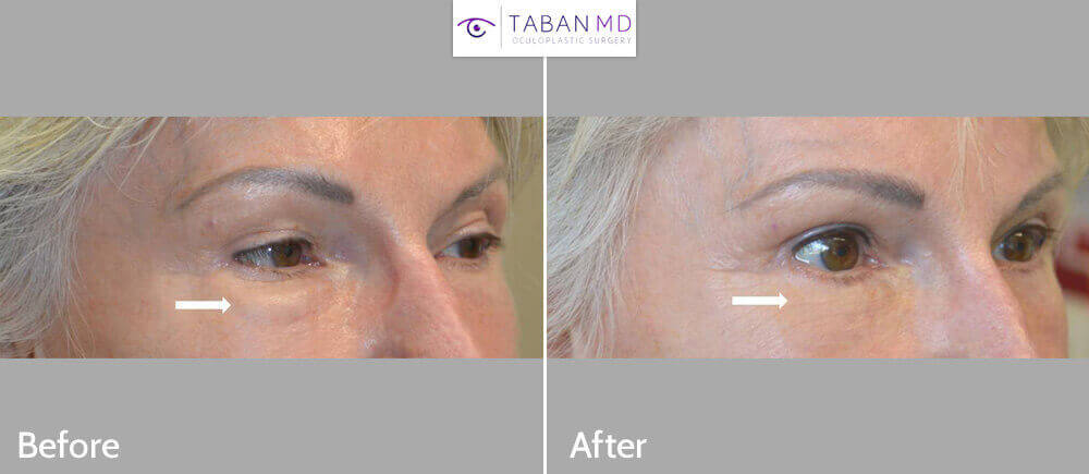 62 year old female, with history of prior under eye fat transfer (eyelid fat injection) resulting in fat lumps underwent revision lower blepharoplasty with removal of fat granuloma lumps. Before and 2 months after revision cosmetic eyelid surgery photos are shown.