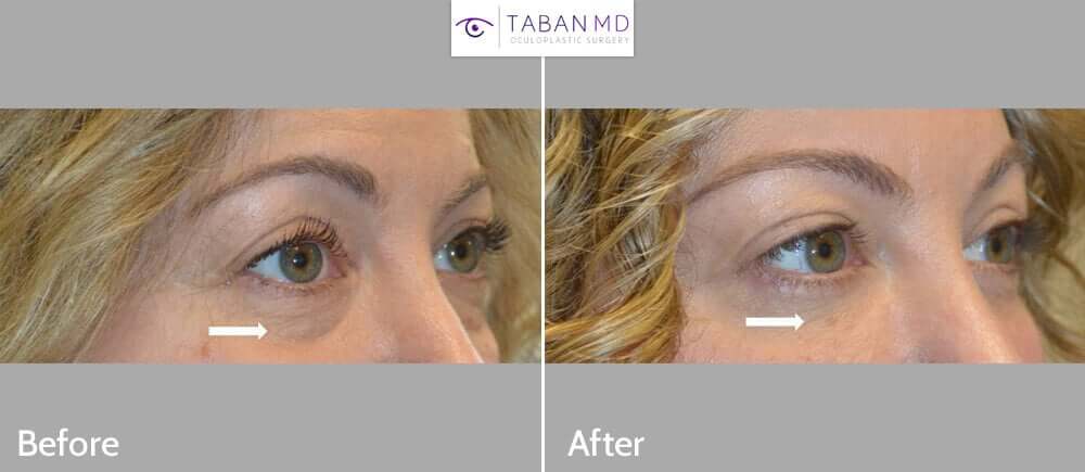 48 year old beautiful woman underwent lower blepharoplasty (transconjunctival technique with fat repositioning plus skin pinch) to give more youthful, rested eye appearance.